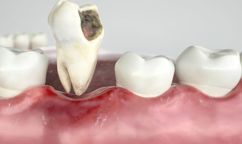 Cần nhổ răng nếu răng bị mục trầm trọng và không thể bảo tồn