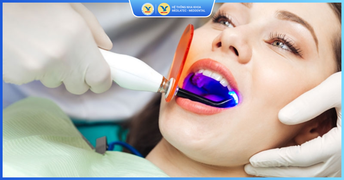 Tẩy trắng răng tại nha khoa - Tẩy trắng răng