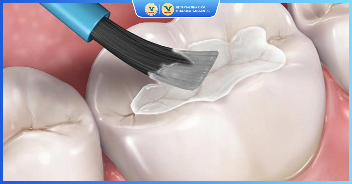 Có những kỹ thuật trám răng nào? - Trám răng thẩm mỹ