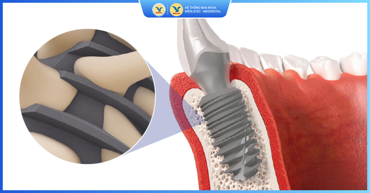Trụ Implant Pháp Tekka - Trồng răng Implant