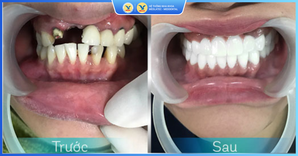 Trường hợp nào không nên áp dụng bọc răng sứ? - Bọc răng sứ thẩm mỹ