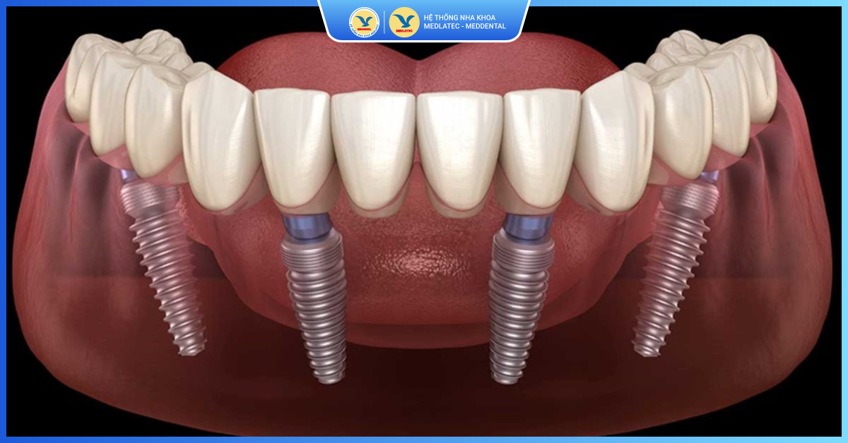 Implant All On 4 - Kỹ thuật Implant All On