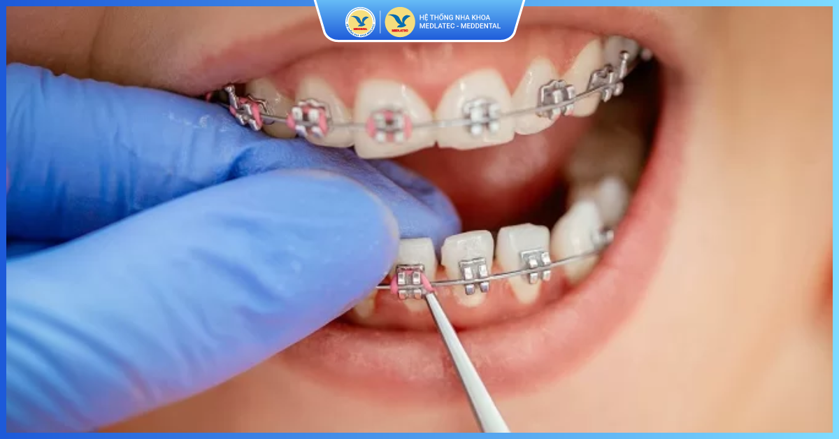 Nhược điểm của niềng răng mắc cài kim loại - Niềng răng mắc cài kim loại