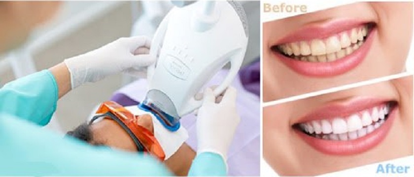 Nên điều trị tại nha khoa trong trường hợp răng ngả màu nghiêm trọng Nên điều trị tại nha khoa trong trường hợp răng ngả màu nghiêm trọng