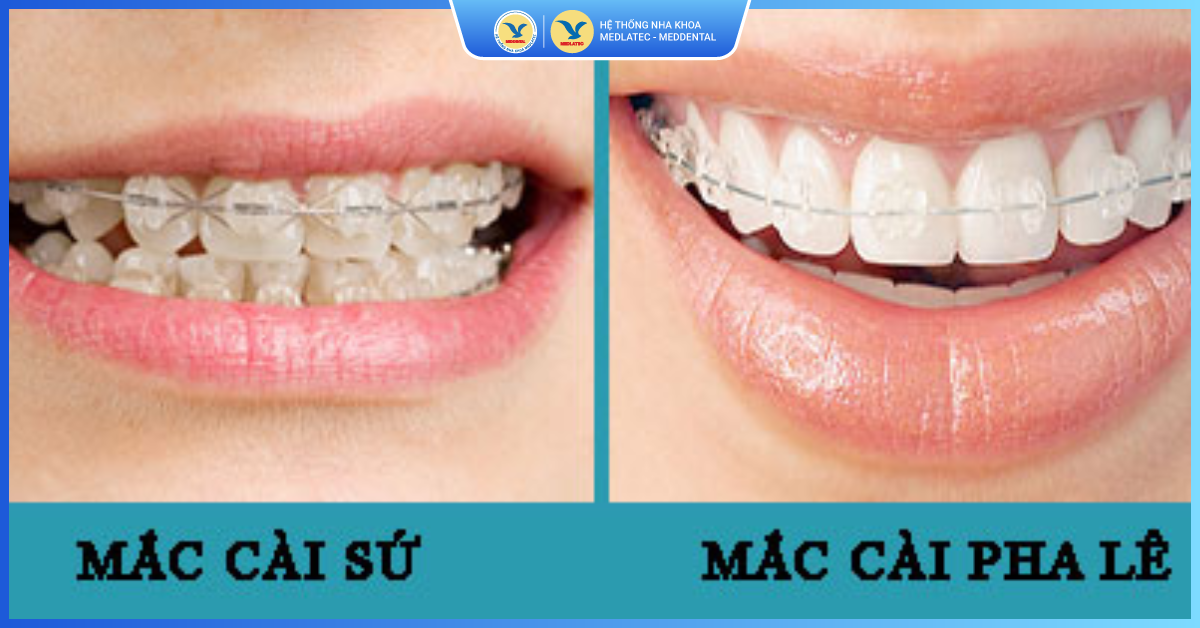 Điểm khác biệt - Niềng răng mắc cài pha lê