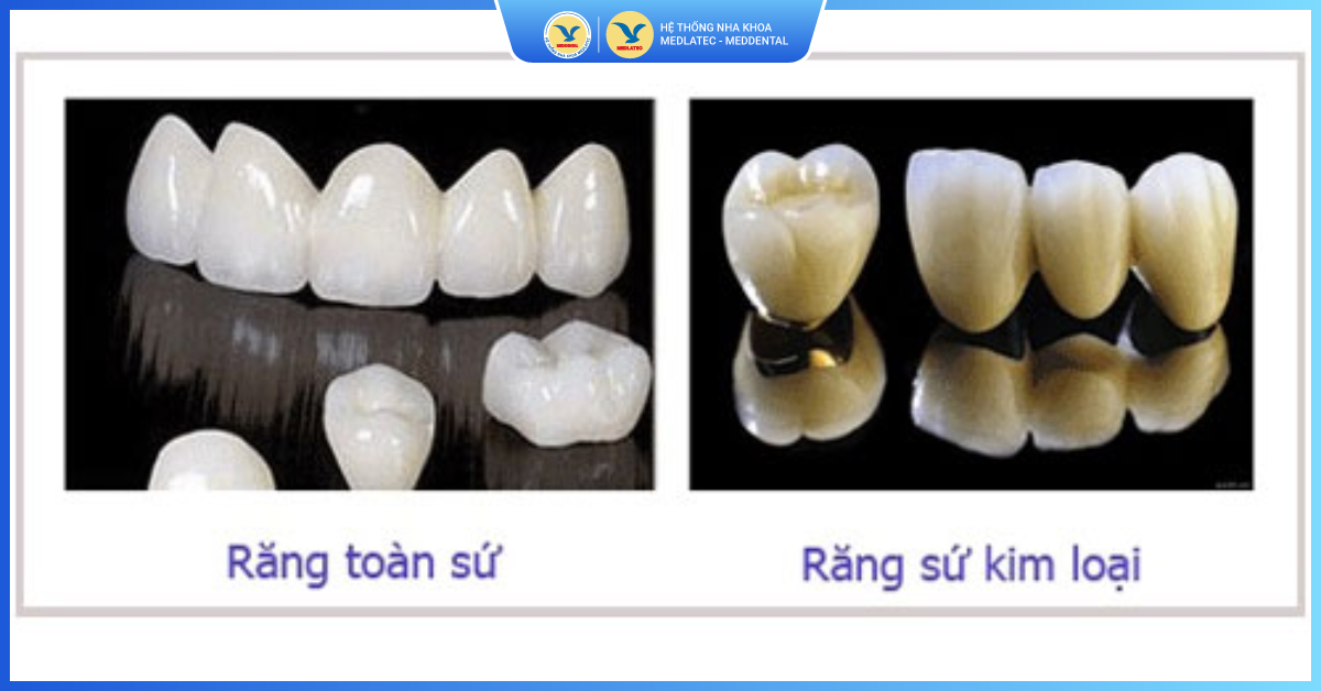 Bọc răng sứ nên chọn loại nào? - Răng toàn sứ