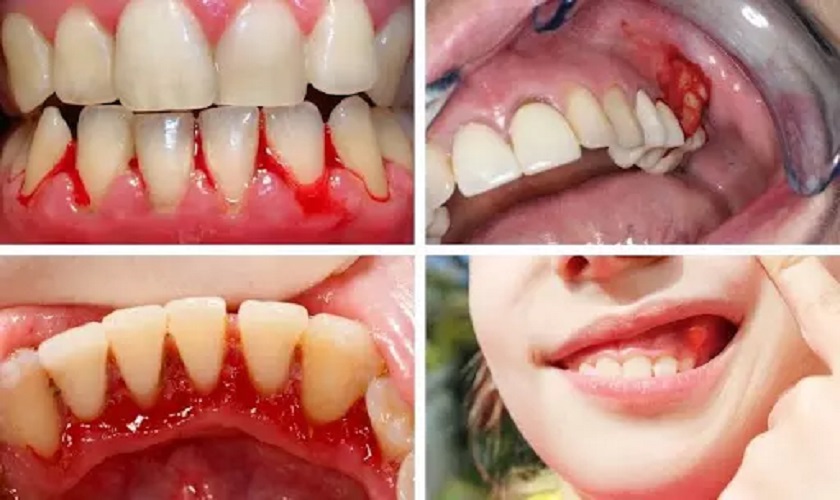 Một bệnh lý về nướu thường gặp phải
