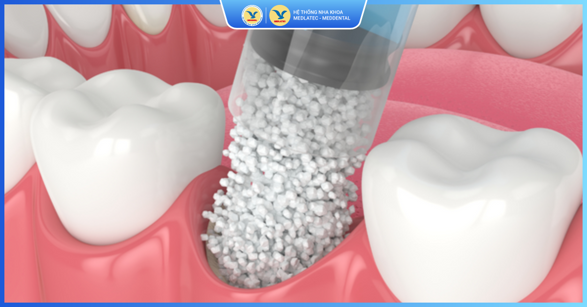 Tác dụng khi ghép xương trong cấy ghép Implant - Ghép xương răng