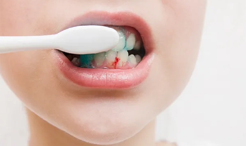 Chảy máu chân răng có thể là dấu hiệu cảnh báo viêm chân răng giai đoạn nhẹ Chảy máu chân răng có thể là dấu hiệu cảnh báo viêm chân răng giai đoạn nhẹ
