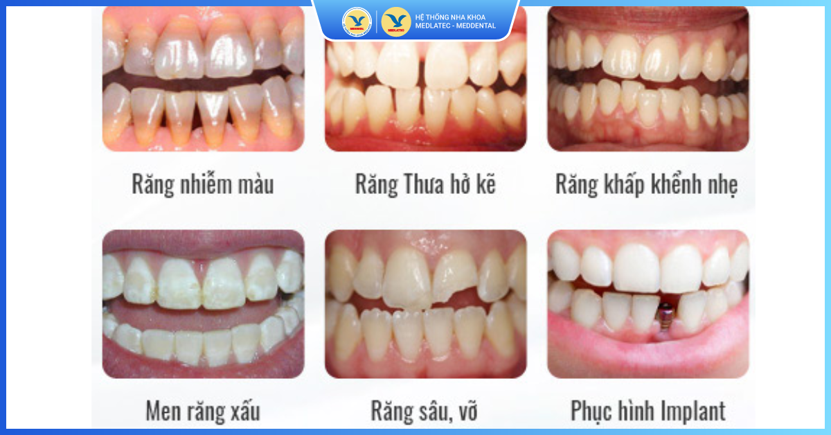 Trường hợp nào nên làm răng sứ toàn hàm? - Răng sứ toàn hàm