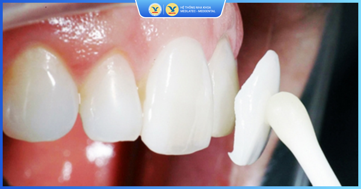 Hạn chế của mặt dán sứ Veneer Ultrathin - Dán sứ Veneer