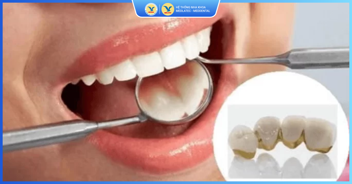 Răng sứ kim loại có tuổi thọ bao lâu mới phải thay? - Răng sứ kim loại