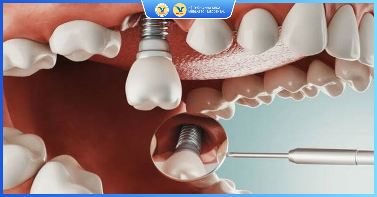Nhược điểm - Trồng răng Implant
