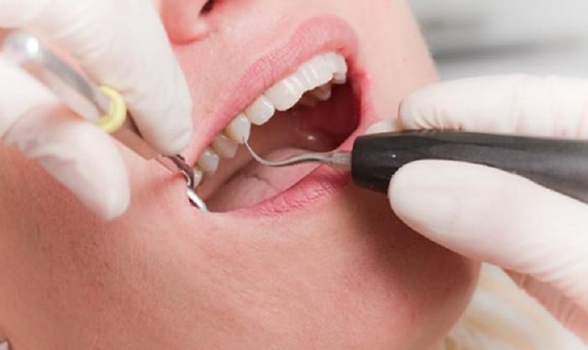 Nên cạo vôi răng định kì để giữ nướu răng khỏe mạnh