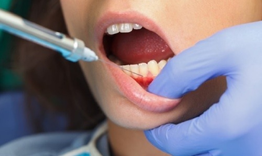 Gây tê trước khi nhổ răng giúp hạn chế tối đa cảm giác đau nhức