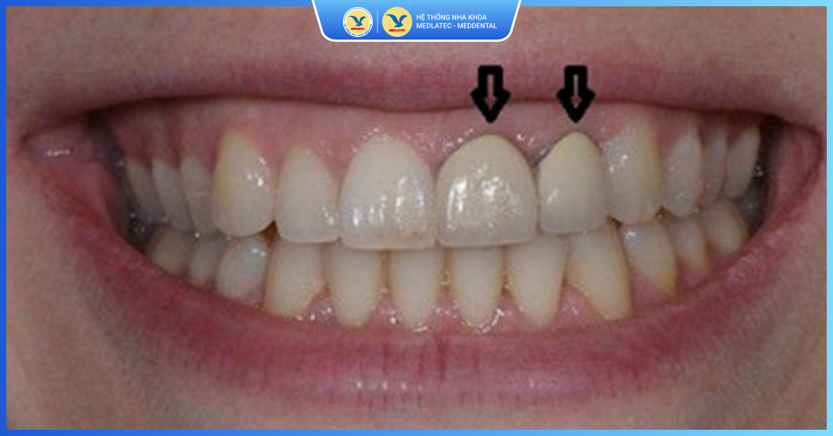 Những tác hại của răng sứ kim loại cần biết - Răng sứ kim loại