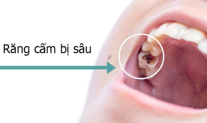 Sâu răng cũng là nguyên nhân khiến răng cấm bị đau Sâu răng cũng là nguyên nhân khiến răng cấm bị đau
