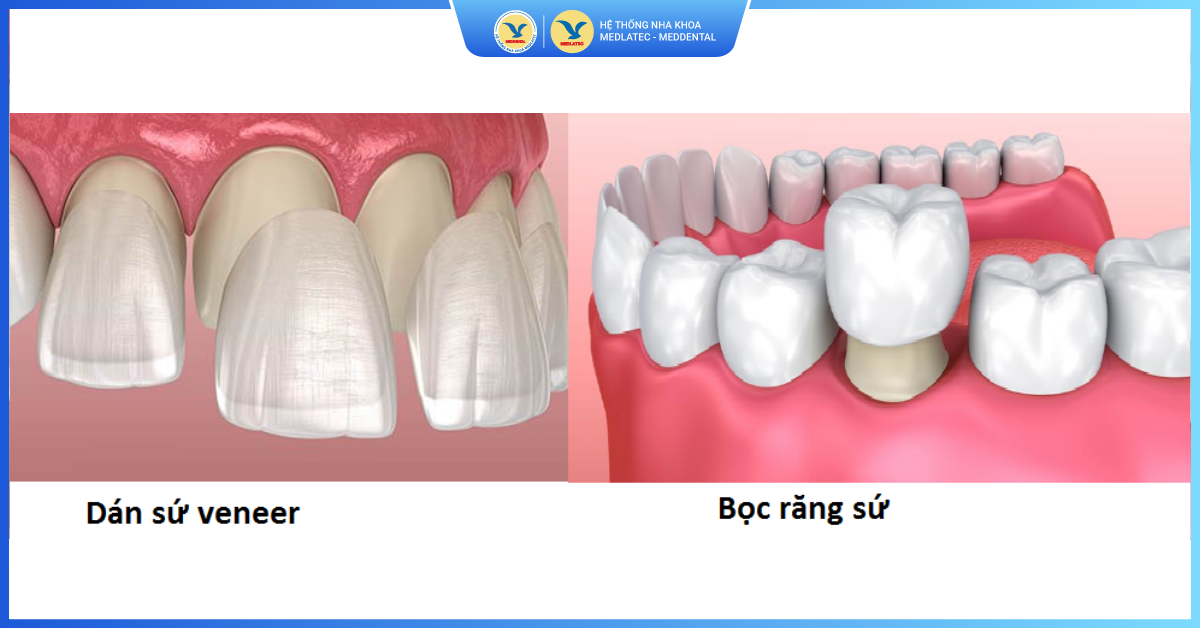 Mặt dán sứ Veneer Ultrathin có tốt không, ưu nhược điểm? - Dán sứ Veneer