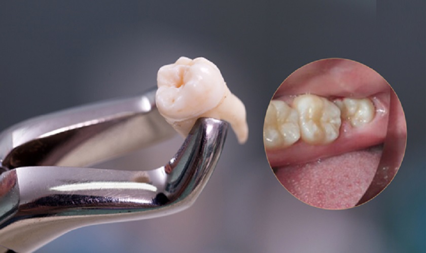 Răng khôn – Răng cối lớn thứ 3 trên cung hàm Răng khôn – Răng cối lớn thứ 3 trên cung hàm