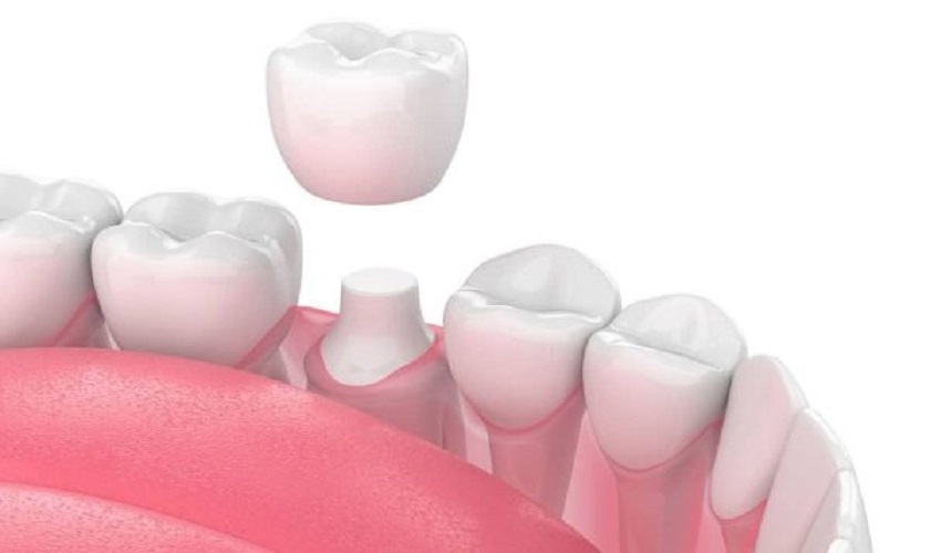 Bọc răng sứ khôi phục răng bị gãy nứt