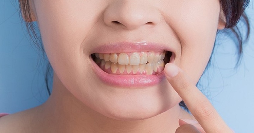 Một vài lưu ý quan trọng trước khi dùng kháng sinh răng lợi Một vài lưu ý quan trọng trước khi dùng kháng sinh răng lợi