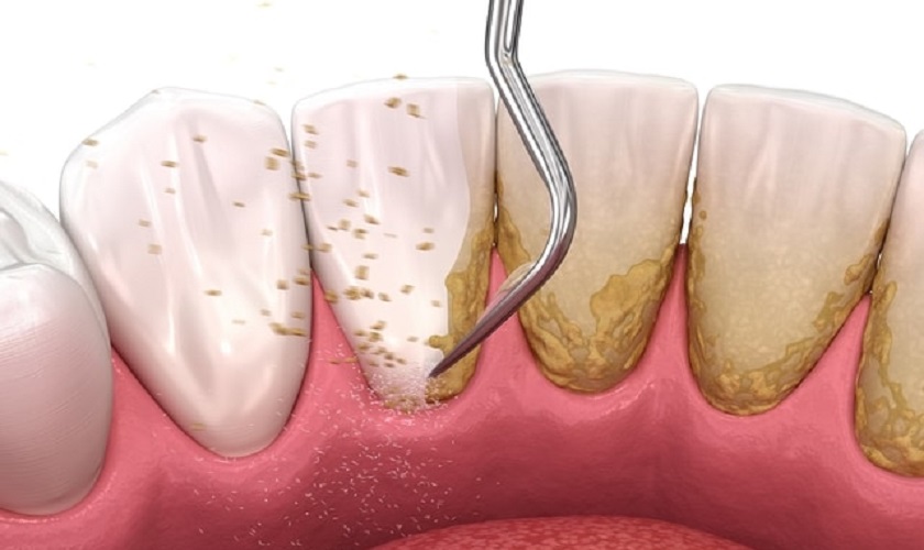 Cạo vôi răng là cách điều trị viêm chân răng hữu hiệu ở giai đoạn nhẹ Cạo vôi răng là cách điều trị viêm chân răng hữu hiệu ở giai đoạn nhẹ
