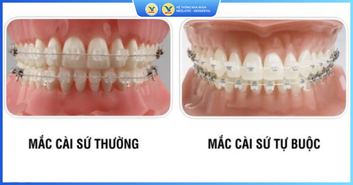 Hai loại niềng răng mắc cài sứ - Niềng răng mắc cài sứ