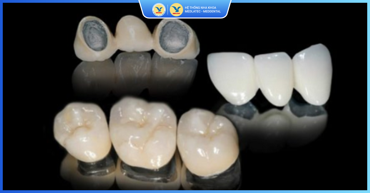 Bước 4: Tạo mão răng sứ kim loại - Răng sứ kim loại