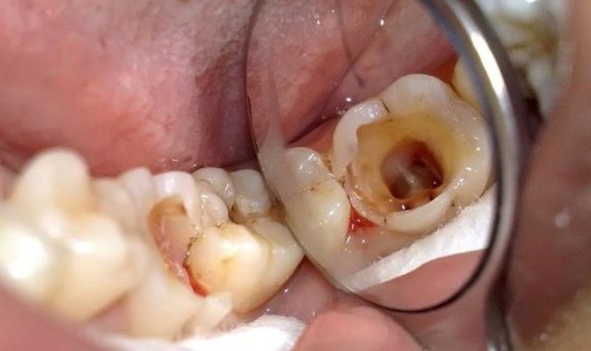 Răng hàm bị vỡ khiến ăn nhai khó khăn Răng hàm bị vỡ khiến ăn nhai khó khăn