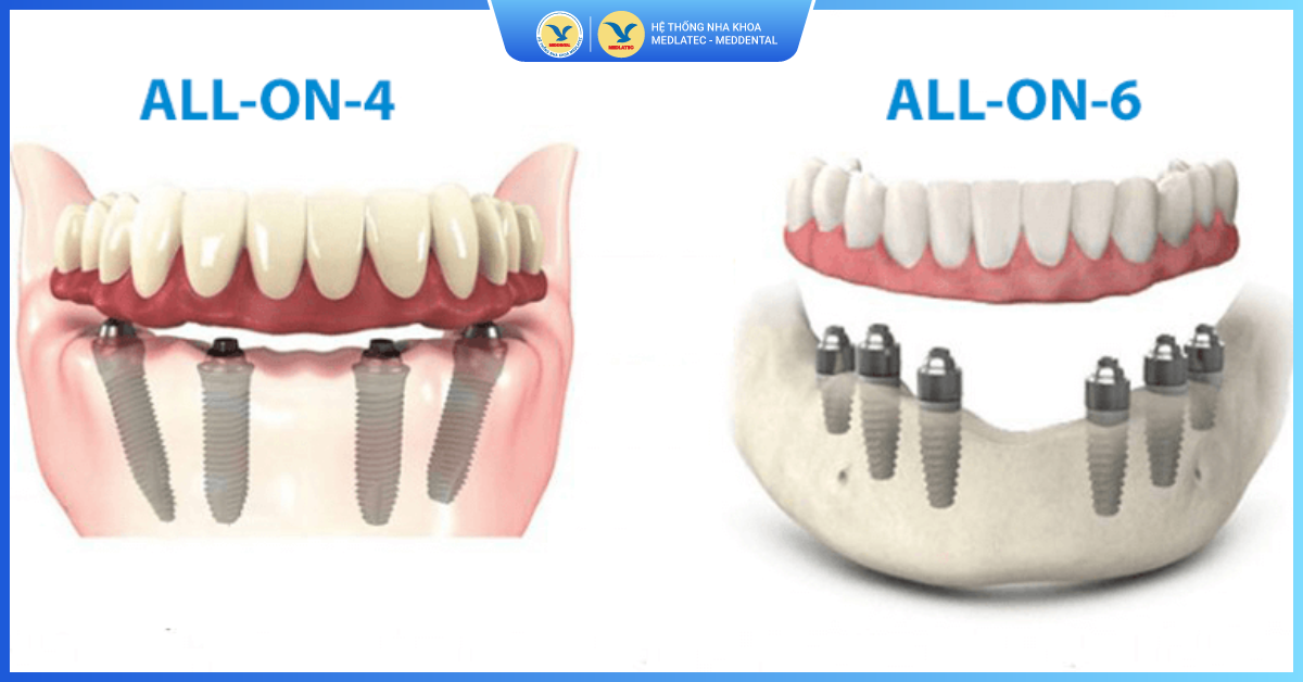 Ưu nhược điểm của Implant All On 6 & 8 - Kỹ thuật Implant All On