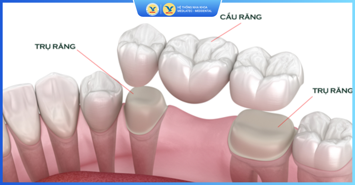Điểm cộng vượt trội khi làm cầu răng sứ - Cầu răng sứ