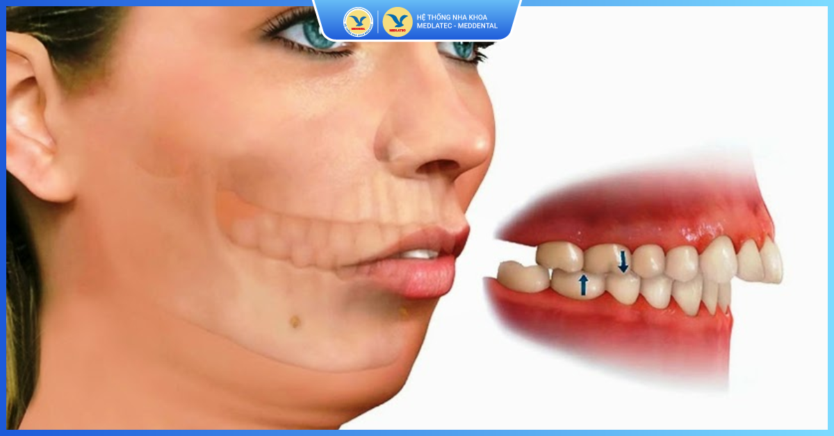 Rủi ro - Chỉnh răng hô móm