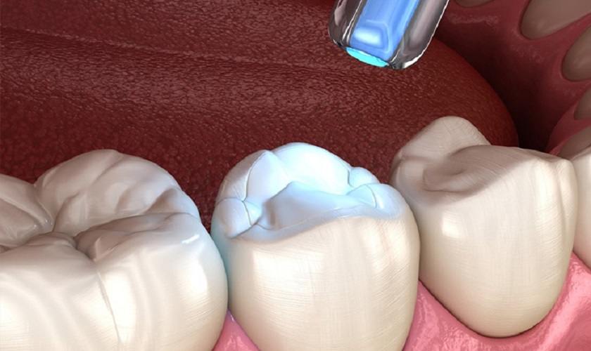 Kỹ thuật trám răng tại nha khoa Kỹ thuật trám răng tại nha khoa