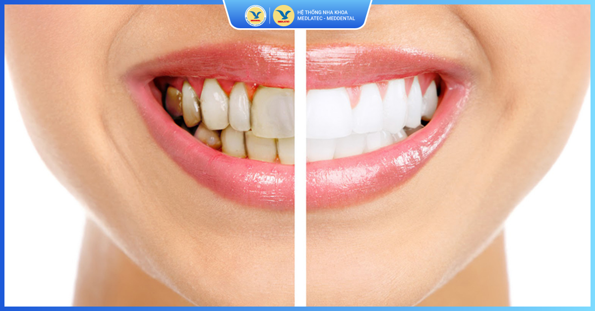 Ưu điểm vượt trội của công nghệ WhiteMax - Tẩy trắng răng