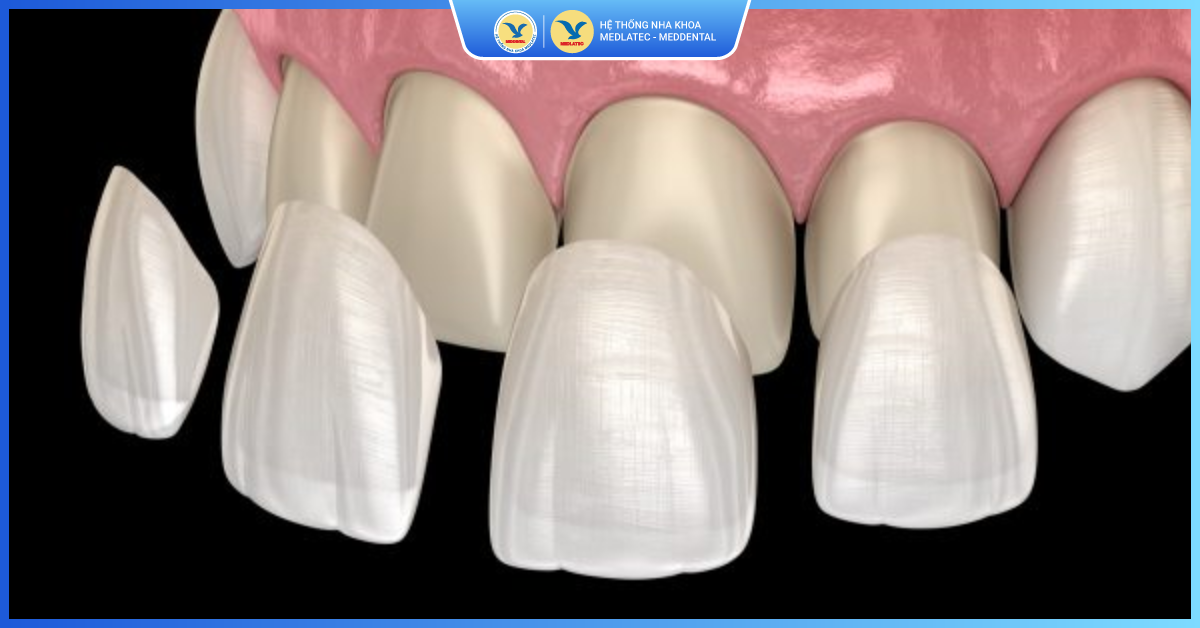 Chi phí cho một mặt dán sứ Veneer Ultrathin là bao nhiêu tiền? - Dán sứ Veneer