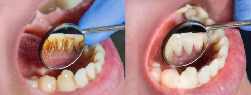 Nên thực hiện cạo vôi răng định kì nhằm ngăn ngừa các bệnh lý răng miệng Nên thực hiện cạo vôi răng định kì nhằm ngăn ngừa các bệnh lý răng miệng