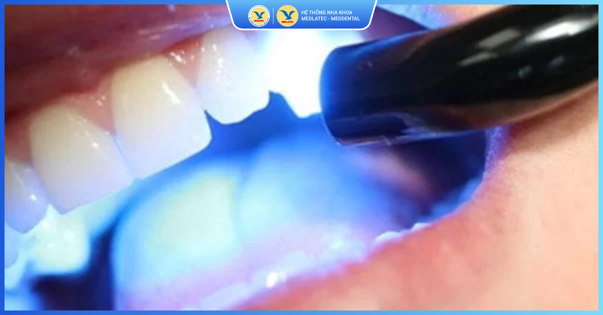 Trám răng Laser Tech – Công nghệ hàn răng hiện đại nhất - Trám răng thẩm mỹ