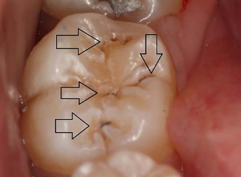 Nguyên nhân gây nhức răng trong cùng hàm dưới