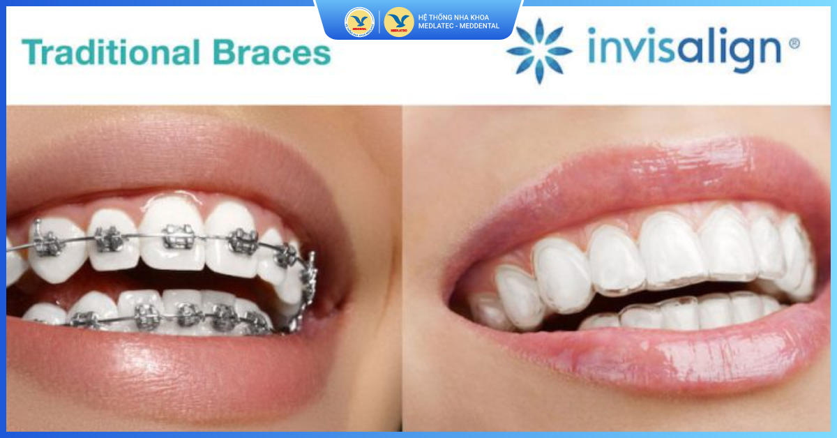 Mang lại hiệu quả chỉnh nha cao - Niềng răng trong suốt Invisalign