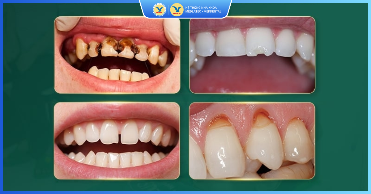 Những trường hợp nào có thể trám răng? - Trám răng thẩm mỹ