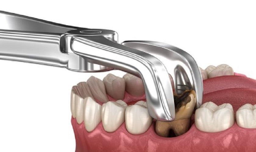 Bạn có thể phải nhổ bỏ răng trong trường hợp viêm chân răng nghiêm trọng Bạn có thể phải nhổ bỏ răng trong trường hợp viêm chân răng nghiêm trọng