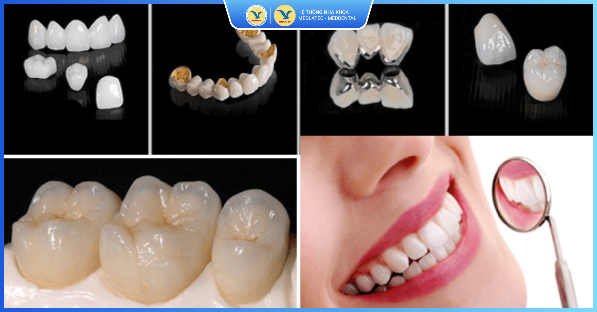 Cầu răng sứ truyền thống - Cầu răng sứ
