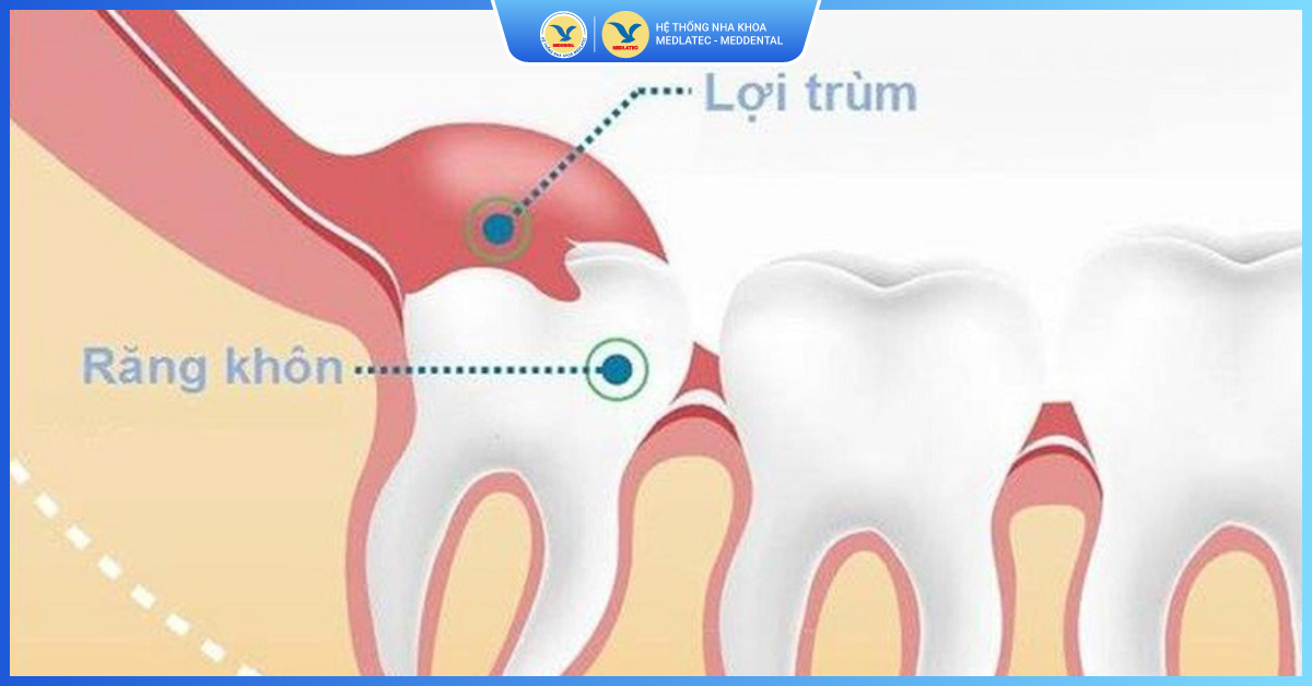 Cắt lợi trùm là gì? Có nên cắt không - Cắt lợi trùm