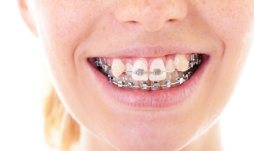 Niềng răng khắc phục tình trạng răng khấp khểnh Niềng răng khắc phục tình trạng răng khấp khểnh