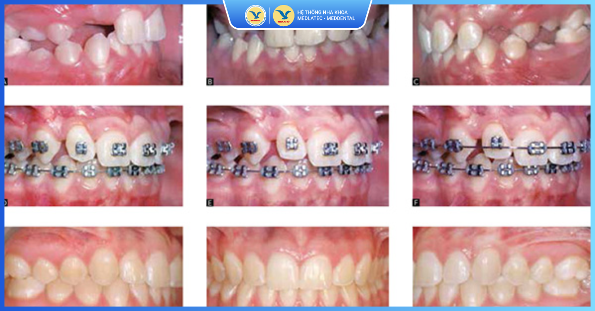 Bước 6: Đeo hàm duy trì - Niềng răng thẩm mỹ