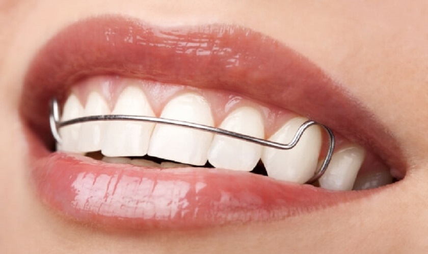 Hàm duy trì cố định kim loại