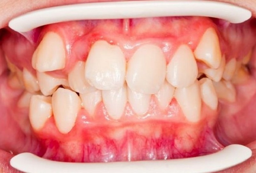 Răng khấp khểnh có thể dẫn đến nhiều hệ quả nghiêm trọng Răng khấp khểnh có thể dẫn đến nhiều hệ quả nghiêm trọng