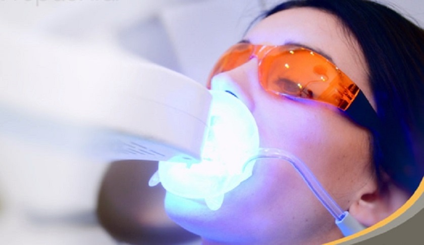 Tẩy trắng răng Laser Whitening tại Nha khoa Nhân Tâm