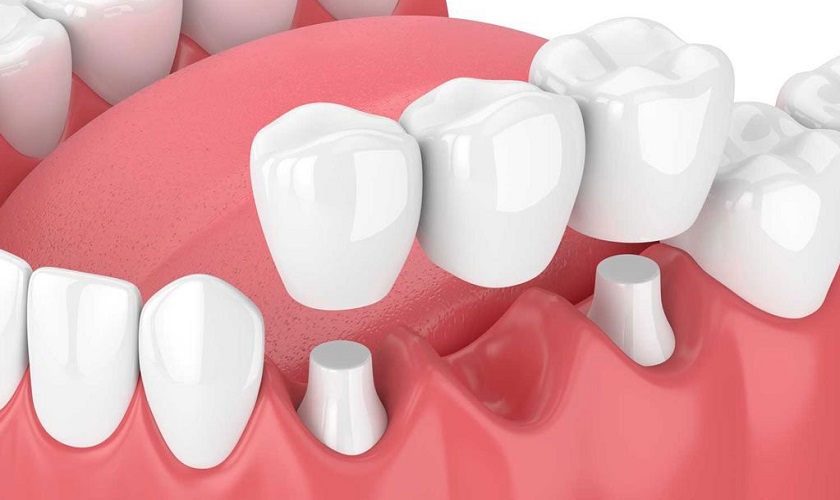 Lợi có thể bị sưng trong vài ngày sau khi trồng răng giả