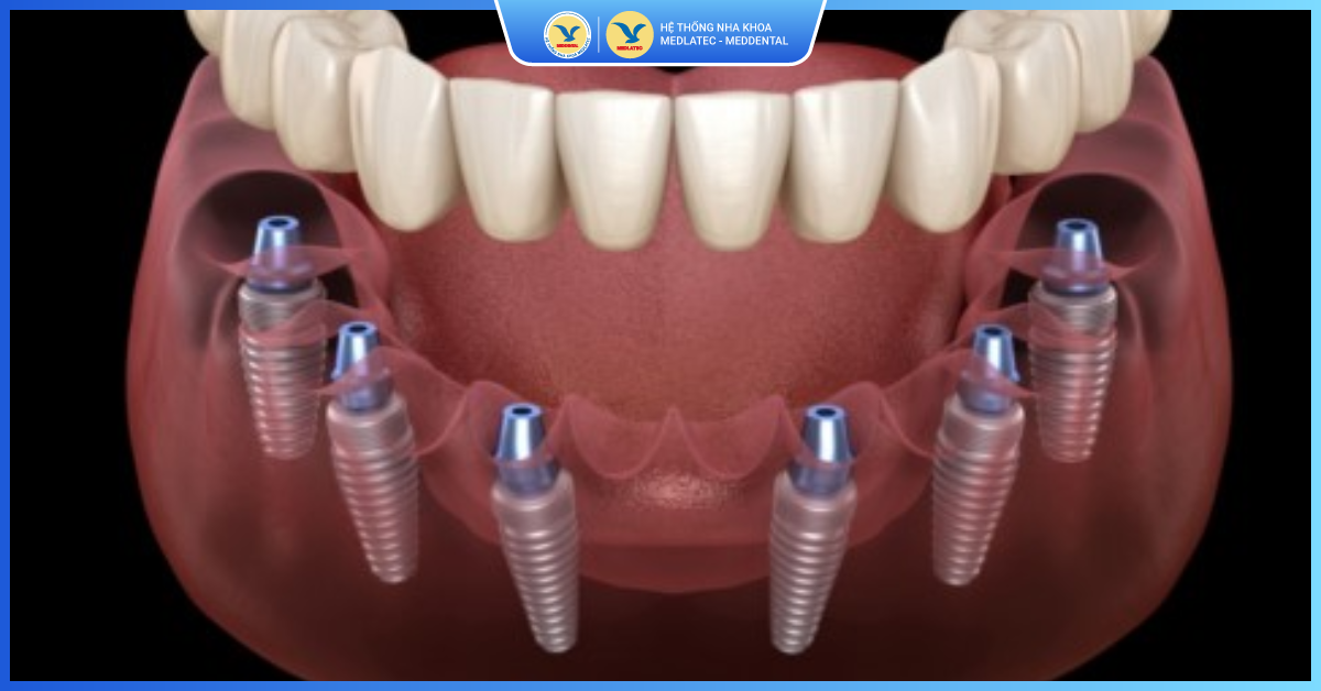 Implant All On 6 - Kỹ thuật Implant All On